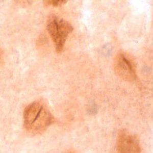  Depósitos de proteína tau con forma de bastón que ocupan los núcleos de determinadas neuronas en pacientes con enfermedad de Huntington. Imagen: Marta Fernández Nogales (Centro de Biología Molecular Severo Ochoa, CSIC)
