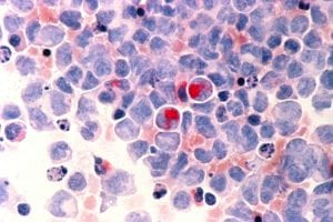 Células humanas con leucemia mieloide aguda. Imagen: Laboratorio del Dr. Liotta. National Cancer Institute. NCI visuals. National Institute of Health, EEUU