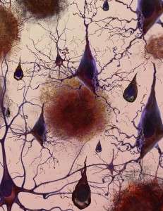 Pérdida de conexiones neriviosas entre las células de los pacientes con Alzhéimer. Imagen: Instituto Nacional de Envejecimiento (NIA), EEUU. Influencia del número de copias del gen APP
