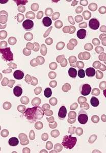 Células B en leucemia linfoblástica crónica. By The Armed Forces Institute of Pathology (AFIP) [Public domain], via Wikimedia Commons