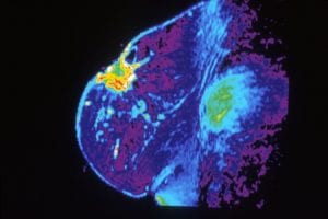 ADN tumoral circulante. Imagen: Dr. Steven Harmes. Baylor University Medical Center (National Institute of Cancer).