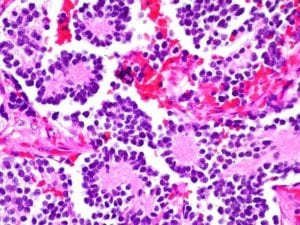 Neuroblastoma de la médula adrenal. Imagen: Ed Uthman (http://creativecommons.org/licenses/by/2.0).