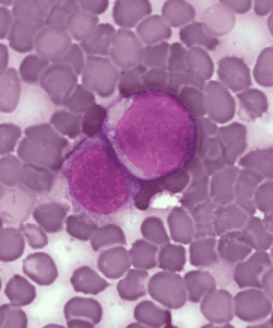 leucemia prolinfocítica. Imagen: A Surprising New Path to Tumor Development. PLoS Biol 3(12): e433. doi:10.1371/journal.pbio.0030433 CC-BY-2.5 