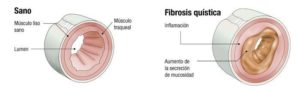 Fibrosis Quística
