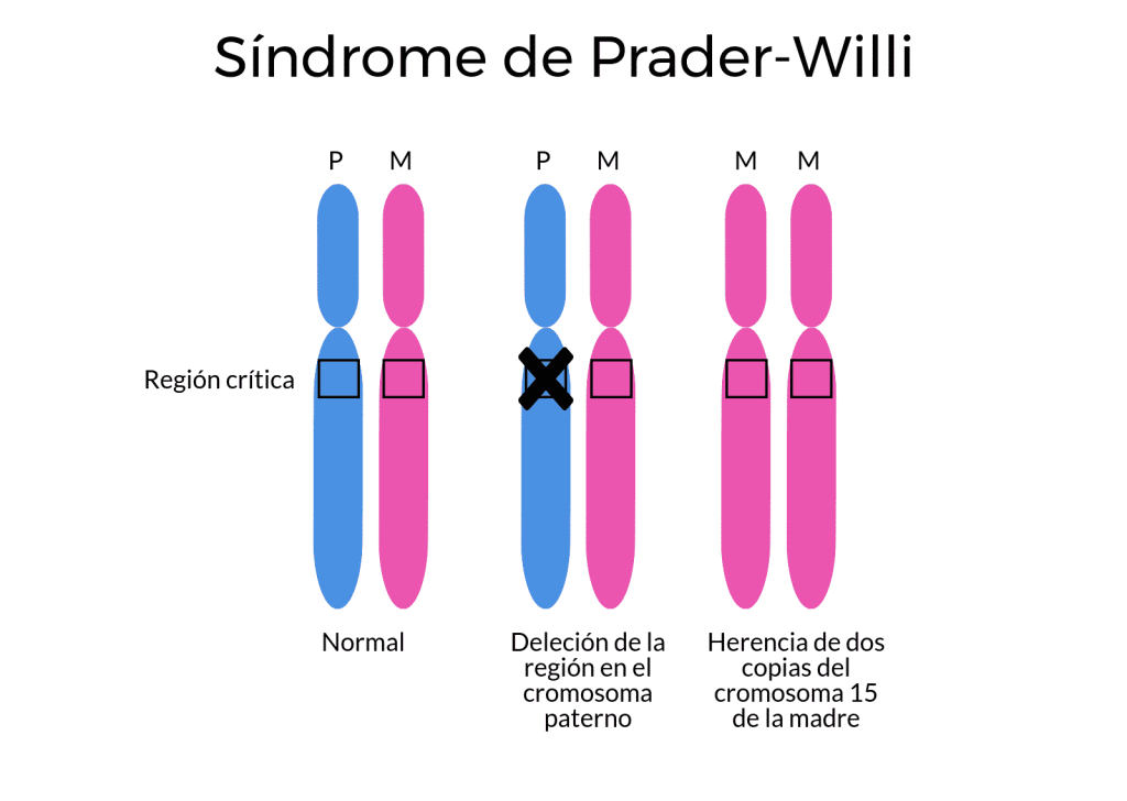 síndrome de prader willi