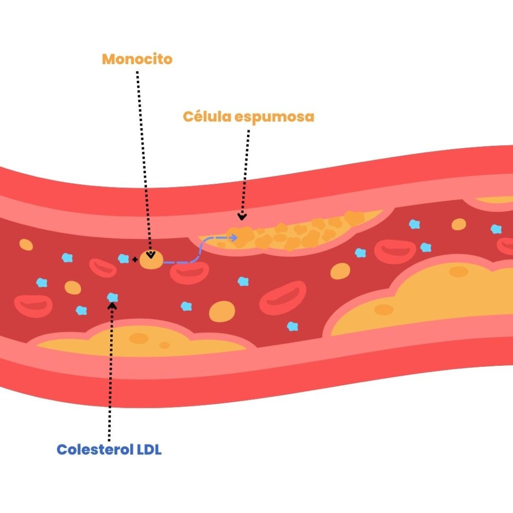 colesterol sangre hipercolesterolemia aterosclerosis