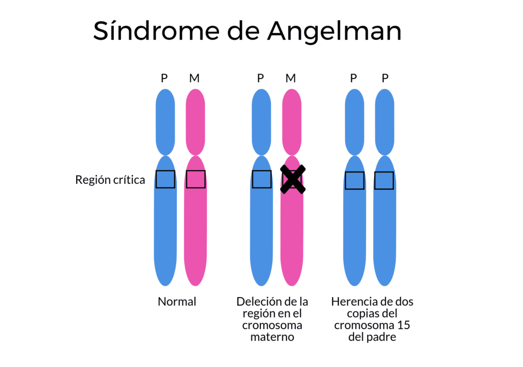 síndrome de angelman