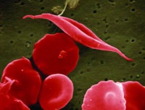 terapia génica anemia falciforme