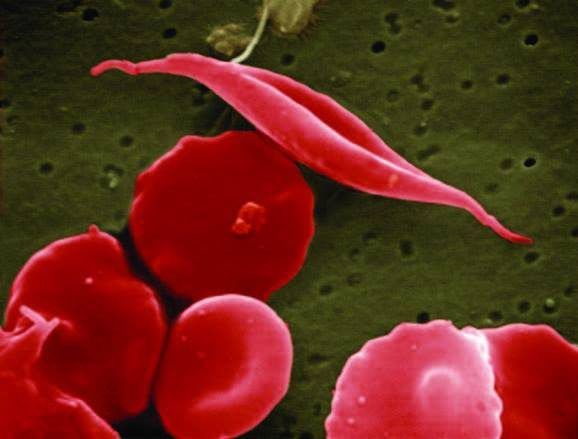 arn celulas madre anemia falciforme