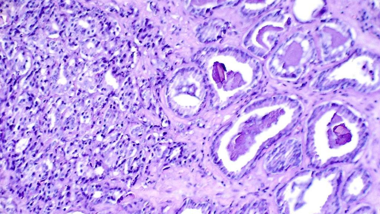 Las muchas opciones para el cáncer de próstata resistente a la castración Las muchas opciones para el cáncer de próstata resistente a la castración