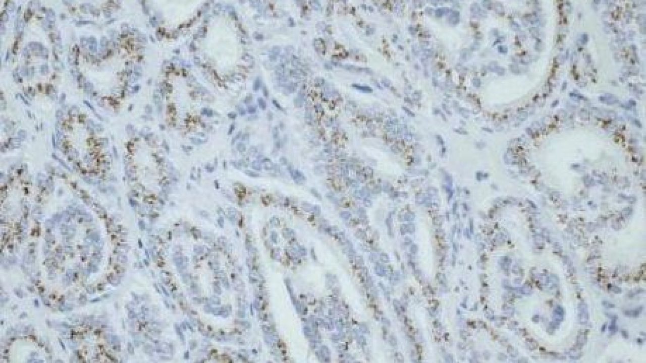 niveles de adenoma de próstata psa