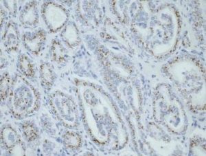 micro-ARNs cáncer próstata