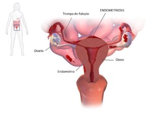 infección endometriosis