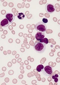 genética leucemia mieloide aguda