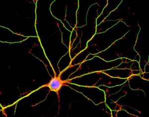 neuronas alzheimer