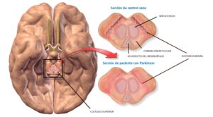 enfermedad de Parkinson