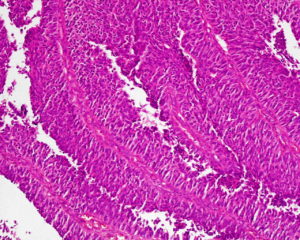 biomarcador cancer urotelial