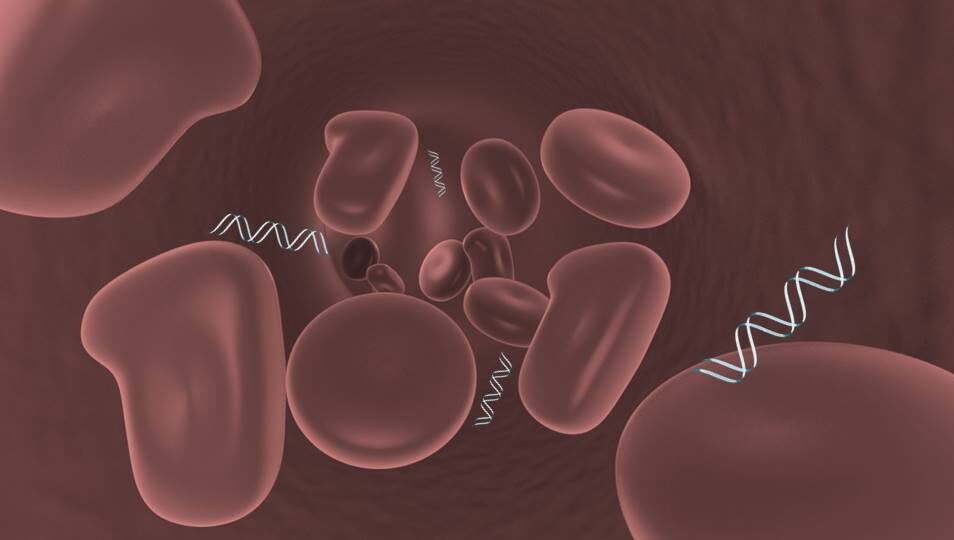 biopsias líquidas en cáncer de páncreas