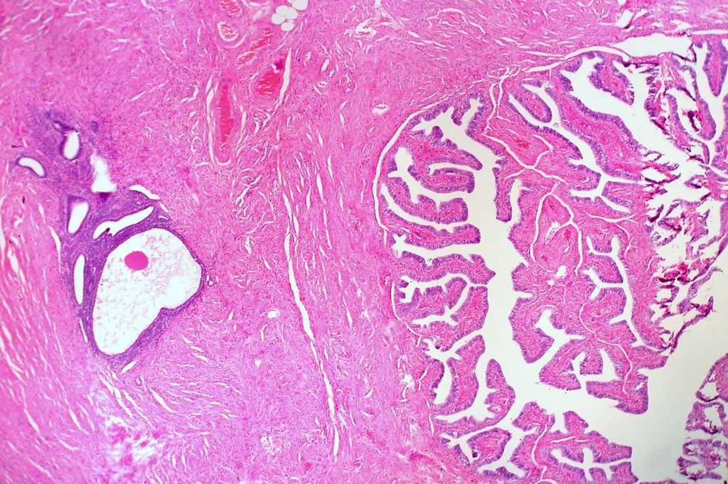 endometriosis lesión celular