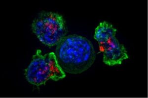 linfocitos modificados cáncer