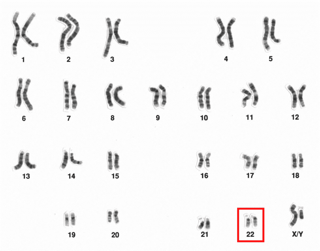 tetrasomía, cromosoma 22