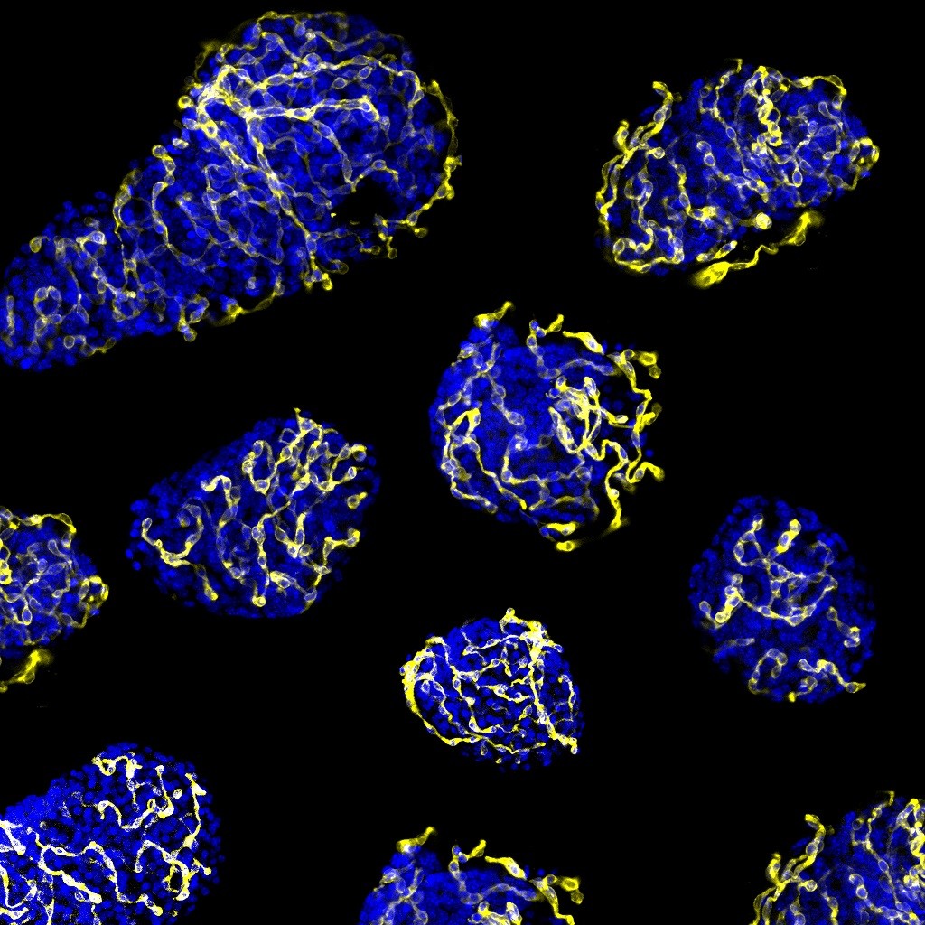 diabetes tipo 1 células pancreáticas