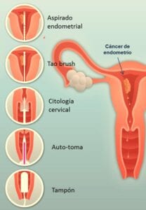 cáncer de endometrio