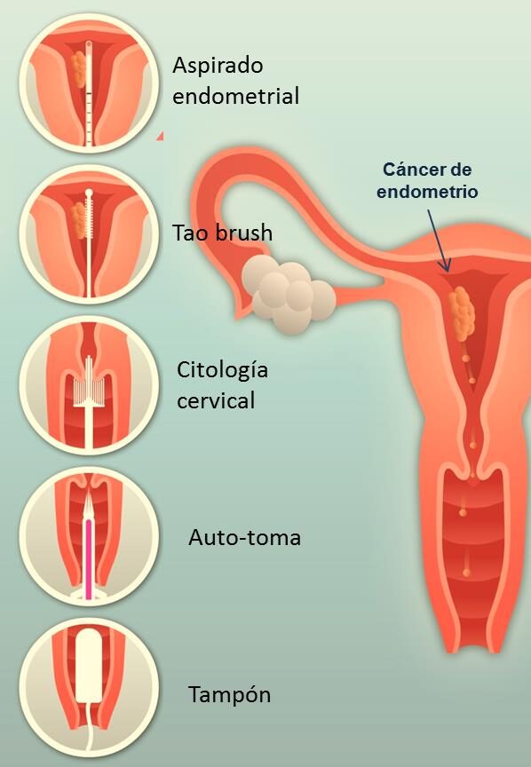 c-ncer-endometrial-genotipia