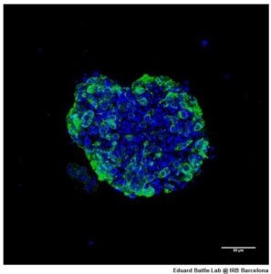 organoides de células tumorales