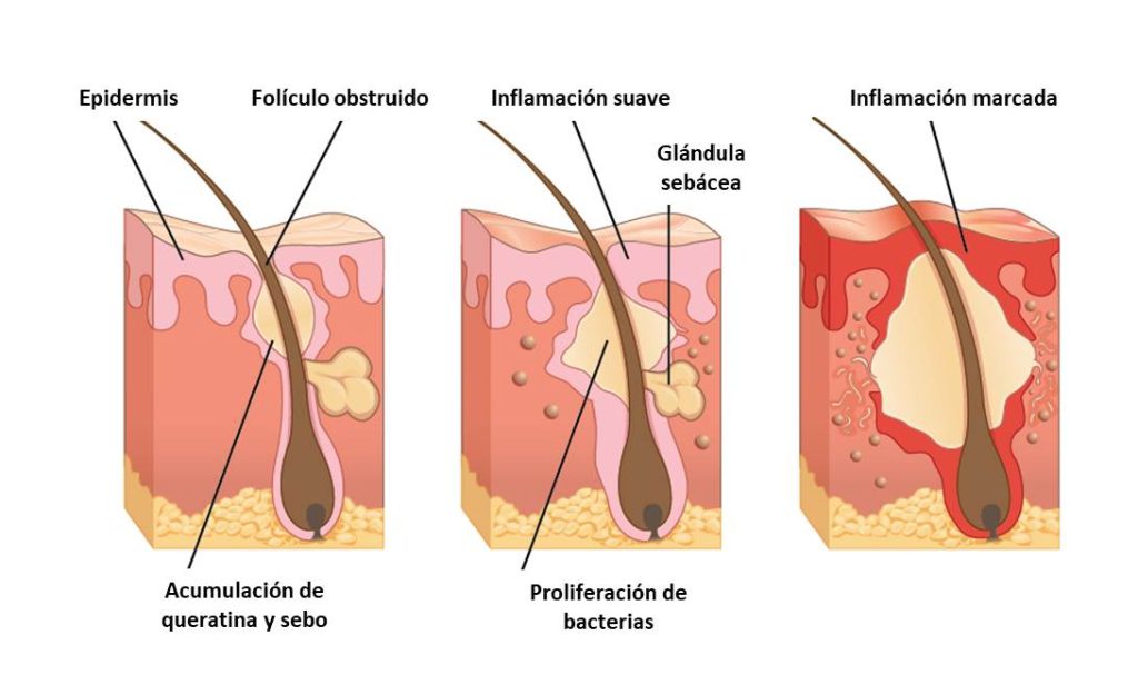 acné inflamación gata6
