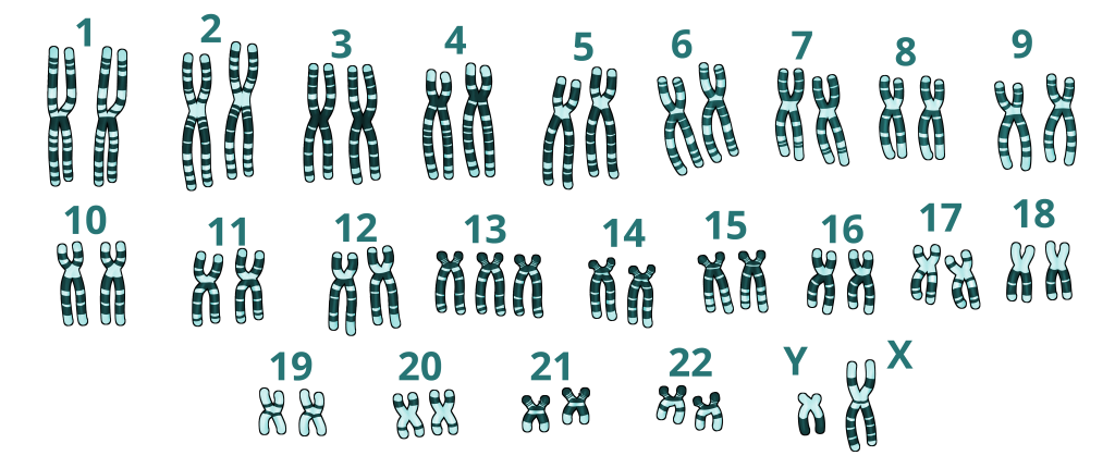 cariotipo de una persona con síndrome de patau