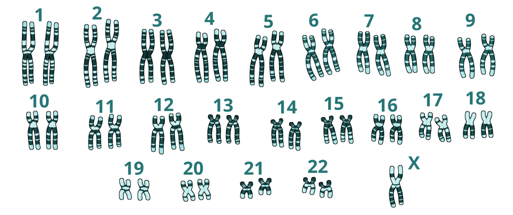 cariotipo de una persona con síndrome de turner