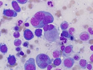 análisis genómico cáncer mieloide