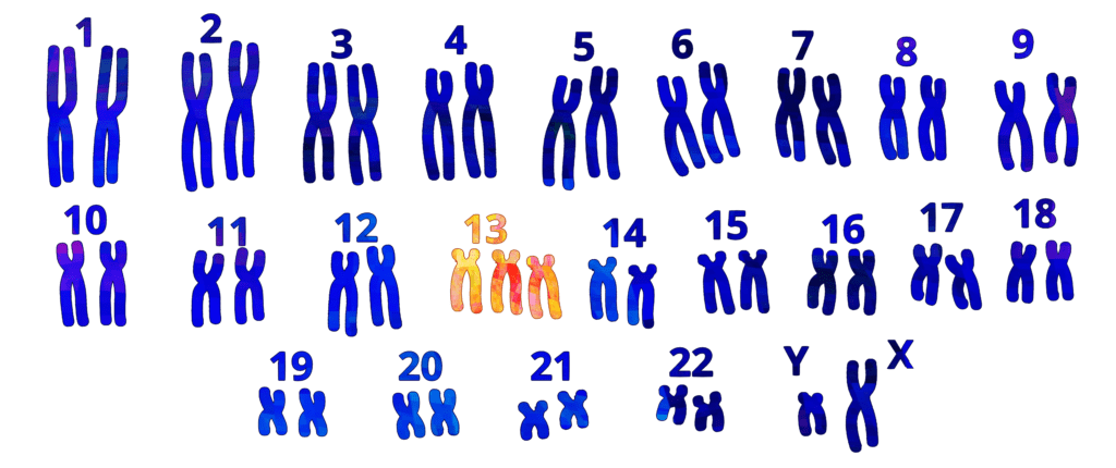 Набор дауна. Синдром Патау трисомия хромосомы 13. Синдром Патау набор хромосом. Синдром Патау частота встречаемости. Синдром Патау кариотип.