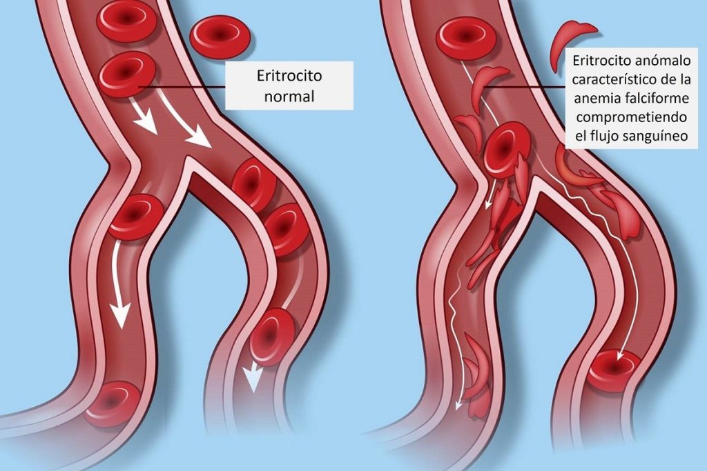 eritrocitos-anemia-falciforme-hgrni-genotipia