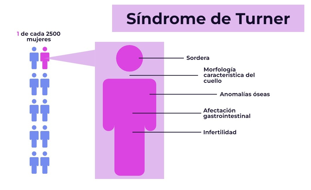 síntomas síndrome de turner