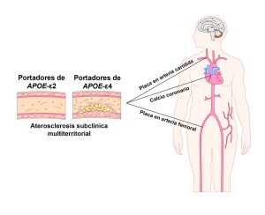 APOE aterosclerosis
