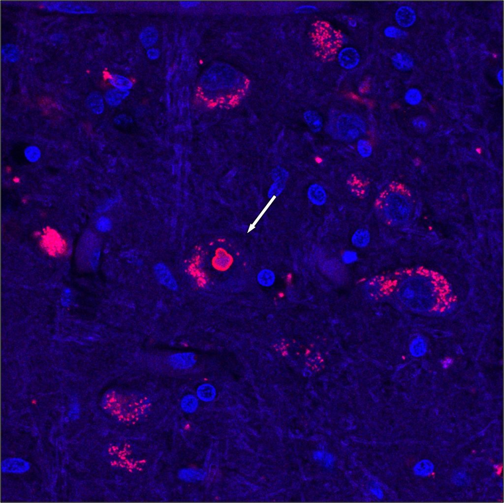 ataxia espinocerebelosa tipo 4