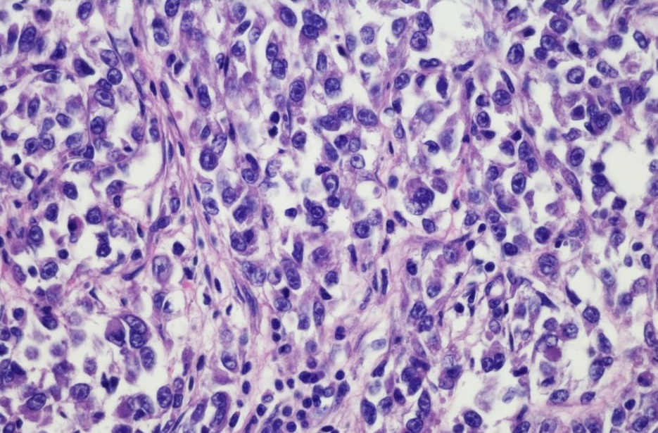 genoma sarcoma