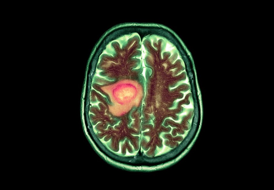 el farmaco vorasidenib aprobado por la FDA para el tratamiento de gliomas de grado 2