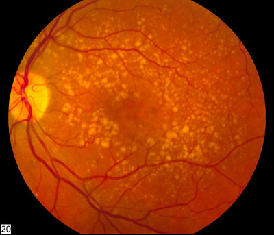 fondo de ojo en degeneracion macular ocular asociada a la edad