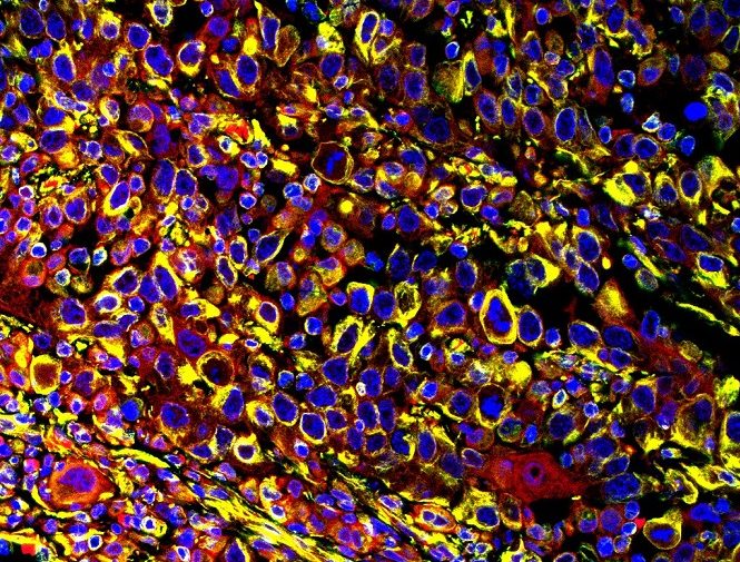 Muestra de tejido tumoral marcado para indicar la presencia de la proteína ITGAV (rojo) y vimentina (verde), un marcador de células mesenquimales. La superposición de ambas proteínas se manifiesta con el color amarillo. El estudio indica que la proteína ITGAV es un biomarcador pronóstico de recaídas de carcinoma escamoso cutáneo