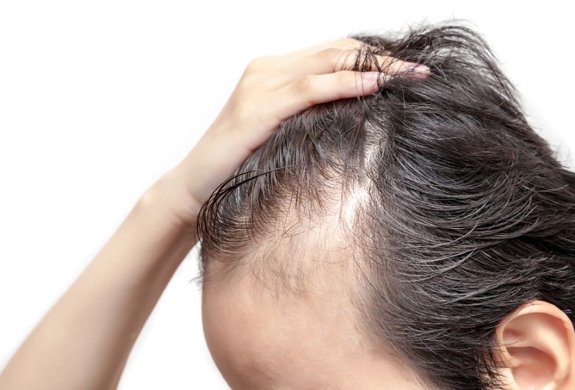 identificado un nuevo gen relacionado con la alopecia hereditaria monilethrix