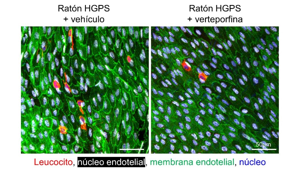  Inmunofluorescencia del lumen arterial de aortas de ratones con síndrome de progeria de Hutchinson-Gilford (HGPS) tratados con vehículo o verteporfina. Las células endoteliales se observan en verde y blanco, y los leucocitos acumulados en la pared arterial en rojo.