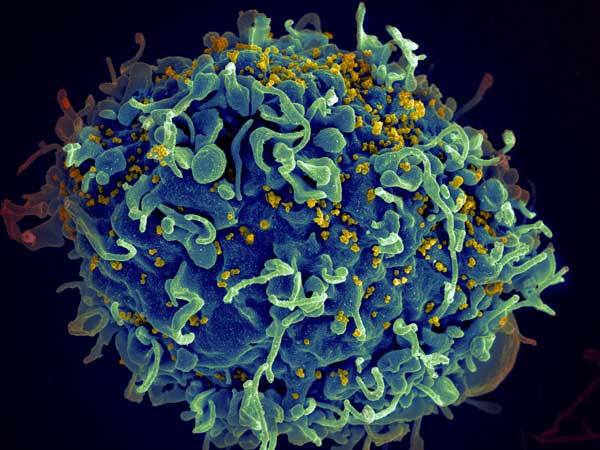 Virus HIV infectando una célula humana Ensayos clínicos evaluarán terapias basadas en CRISPR dirigidas a eliminar el virus integrado en el genoma que puede reactivar la infección.