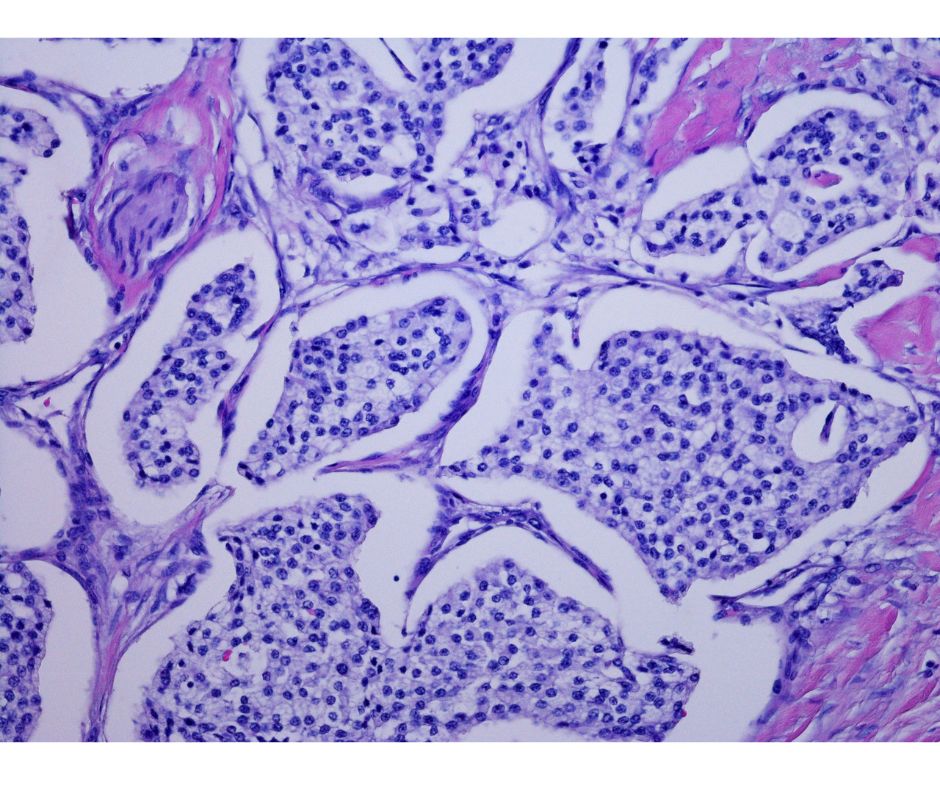 Los avances en genética están impulsando el desarrollo de tratamientos de precisión para tumores de cáncer de páncreas con mutaciones específicas.