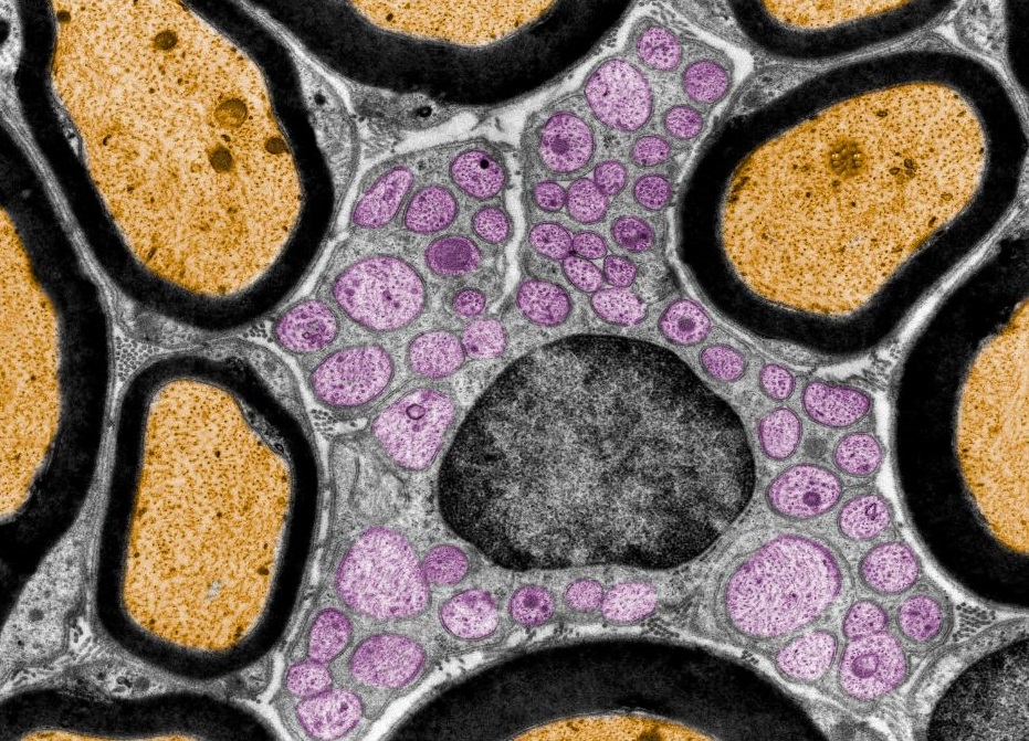 Una terapia génica mejora síntomas de adrenoleucodistrofia, enfermedad metabólica que afecta a la formación de mielina. La imagen muestra una captura de microscopio electrónico de tejido nervioso, donde la mielina que recubre terminaciones nerviosas se muestra en negro