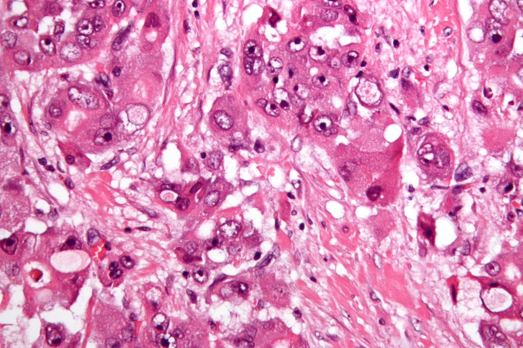 Carcinoma hepatocelular como el utilizado para estudiar el crecimiento tumoral