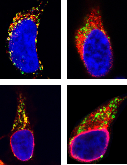 Las proteínas de cola corta (visualizadas en rojo) se entrelazan con éxito en la membrana celular, alcanzando la membrana del orgánulo lisosoma (verde); el color amarillo resultante señala que los marcadores rojo y verde se han fusionado, lo que significa que las proteínas habían alcanzado su destino adecuado. Derecha: Las proteínas anormales características de trastornos genéticos raros no se habían entretejido con éxito en la membrana porque sus colas eran menos hidrófobas; como resultado, los marcadores rojo y verde permanecen separados. Los núcleos celulares aparecen en azul. Imagen: Weizmann Institute of Science.