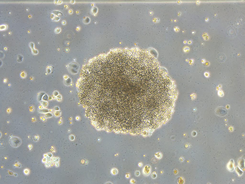 Cambios en el estrés osmótico de las células tumorales pueden generar resistencia o sensibilidad al Rigosertib, fármaco de quimioterapia prometedor en fase experimental para inhibir el crecimiento de las células cancerosas. En la imagen, una colonia de células de cáncer de mama resistente al fármaco Rigosertib, 
rodeada de células que han parado su proliferación gracias al fármaco. Fuente: IIBM, CSIC-UAM.